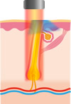 毛根が発熱