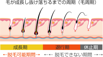 レーザー脱毛のご説明