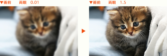 術前 両眼 0.01 術前 両眼 1.5