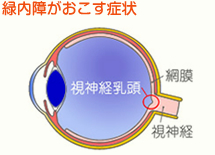 緑内障が起こす症状