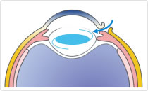 眼内レンズを挿入
