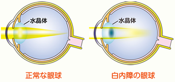 正常な眼球 白内障の眼球 図