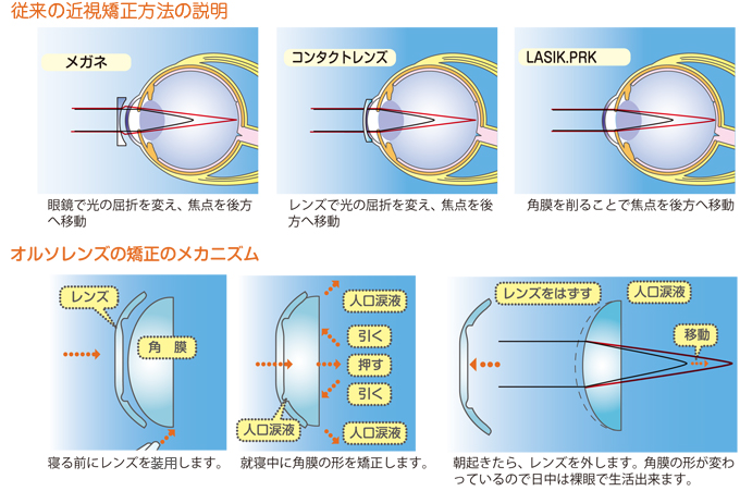 オルソケラトロジー(ナイトレンズ）の矯正メカニズム図