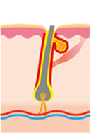 その熱でまわりの発毛組織を変性